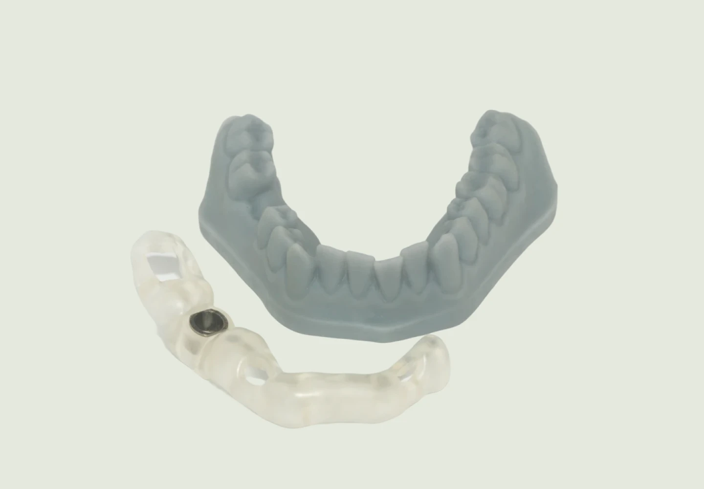 Guide chirurgical posé sur un modèle dentaire, utilisé pour la chirurgie implantaire guidée