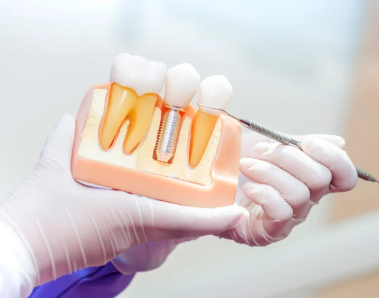 Modèle en coupe d’un implant dentaire et de sa couronne, présenté à la sonde