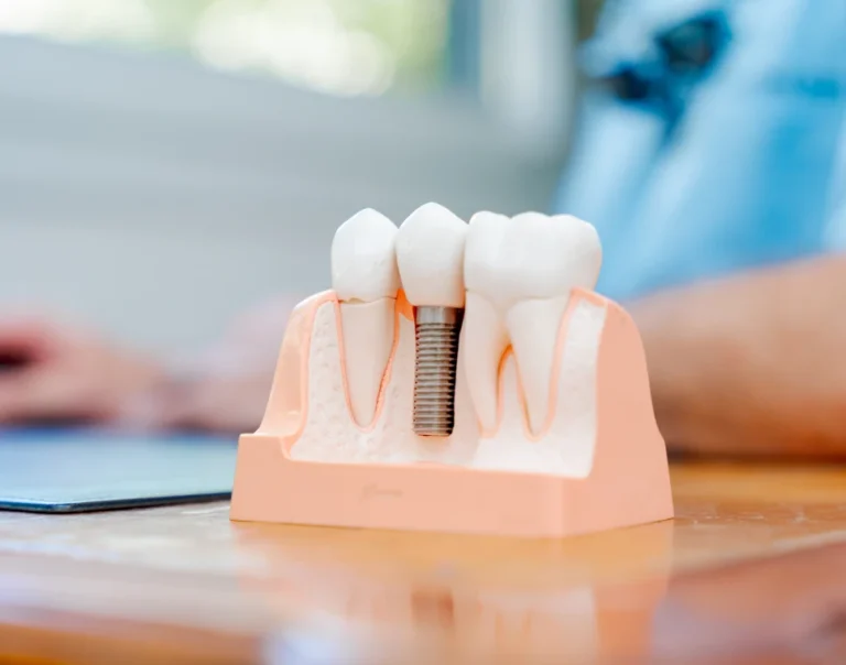 Maquette dentaire montrant un implant entre deux dents naturelles